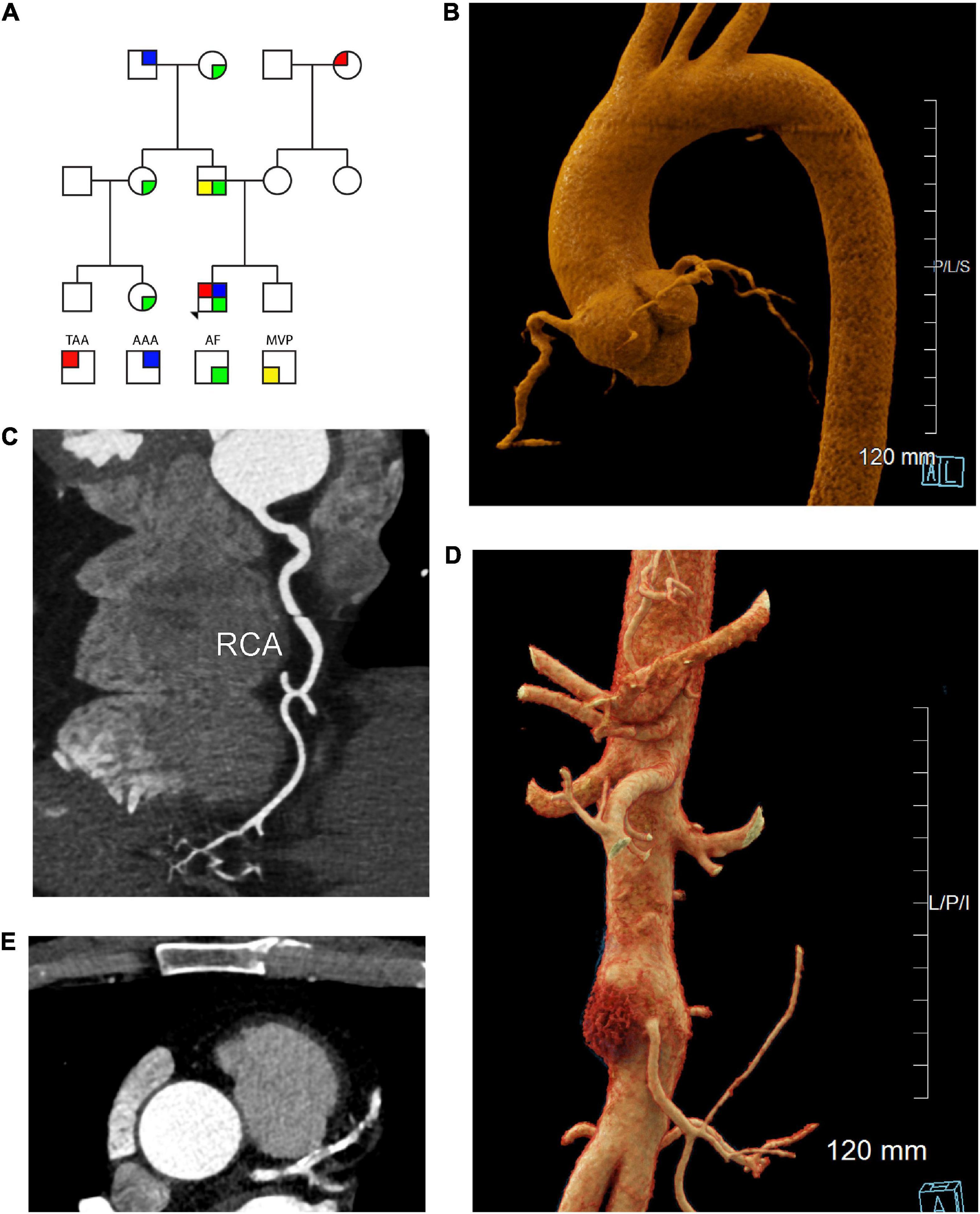 Novel SMAD3 variant identified in a patient with familial aortopathy modeled using a zebrafish embryo assay
